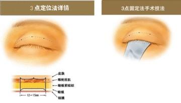 微整形培训之韩式三点定位技术